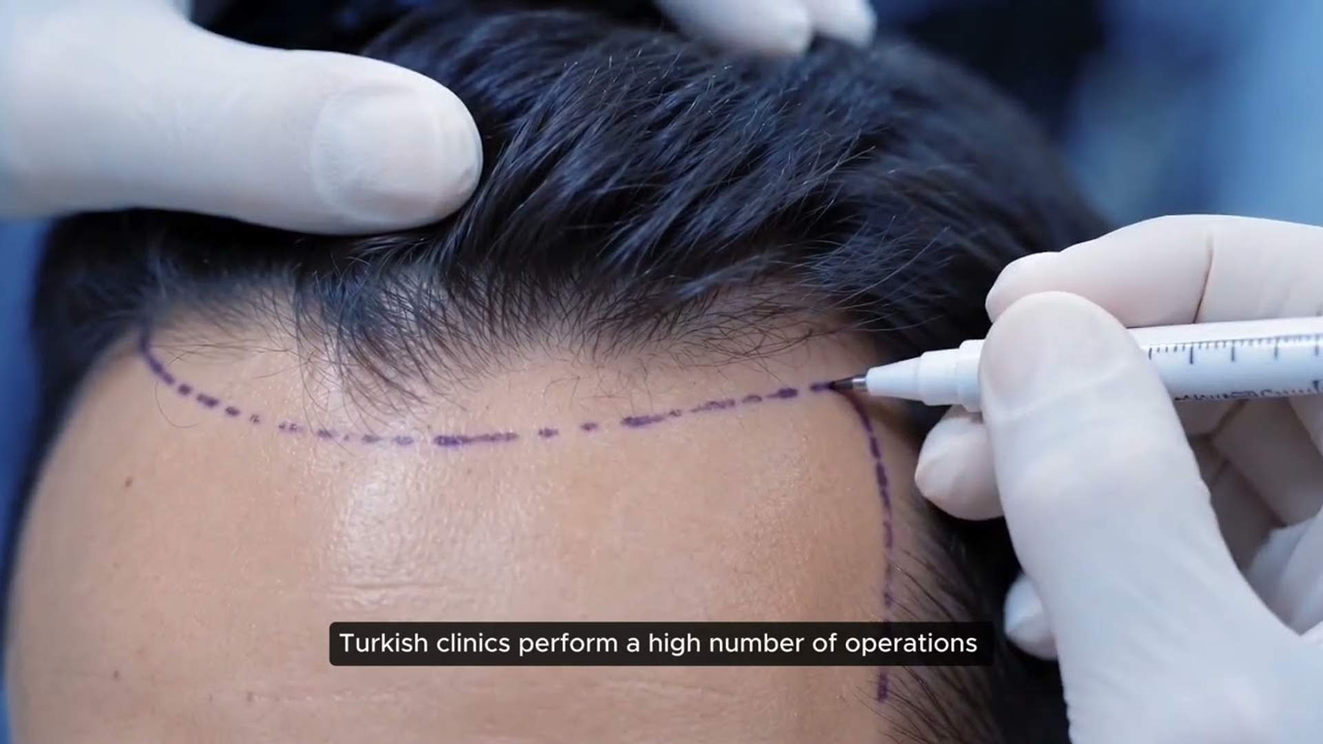 Hair Transplant Cost: Turkey vs UK — How Much You Save (Video)