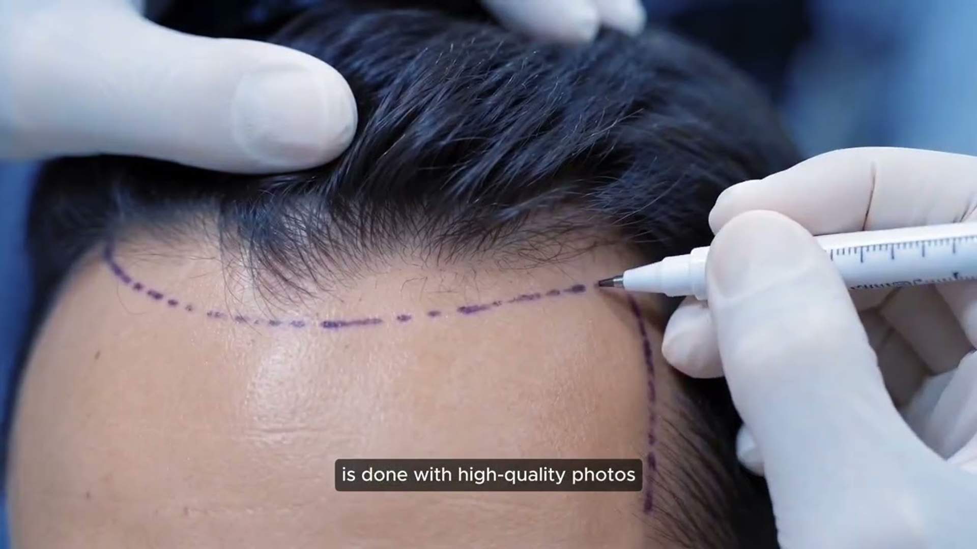 Hair Transplant Consultation: What Doctors Check (Video)
