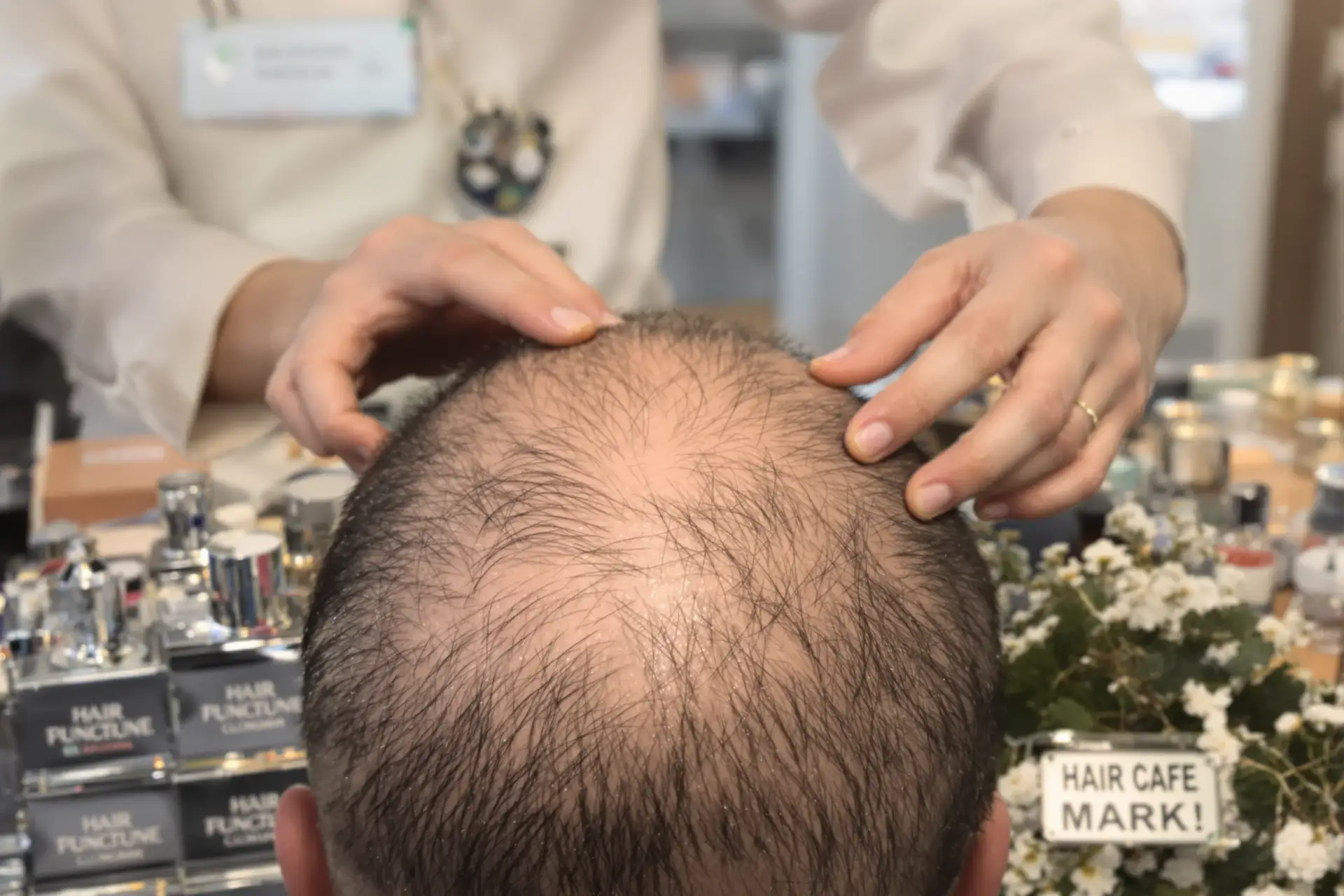 Haartransplantation in der Türkei bei vernarbter Kopfhaut: Was funktioniert