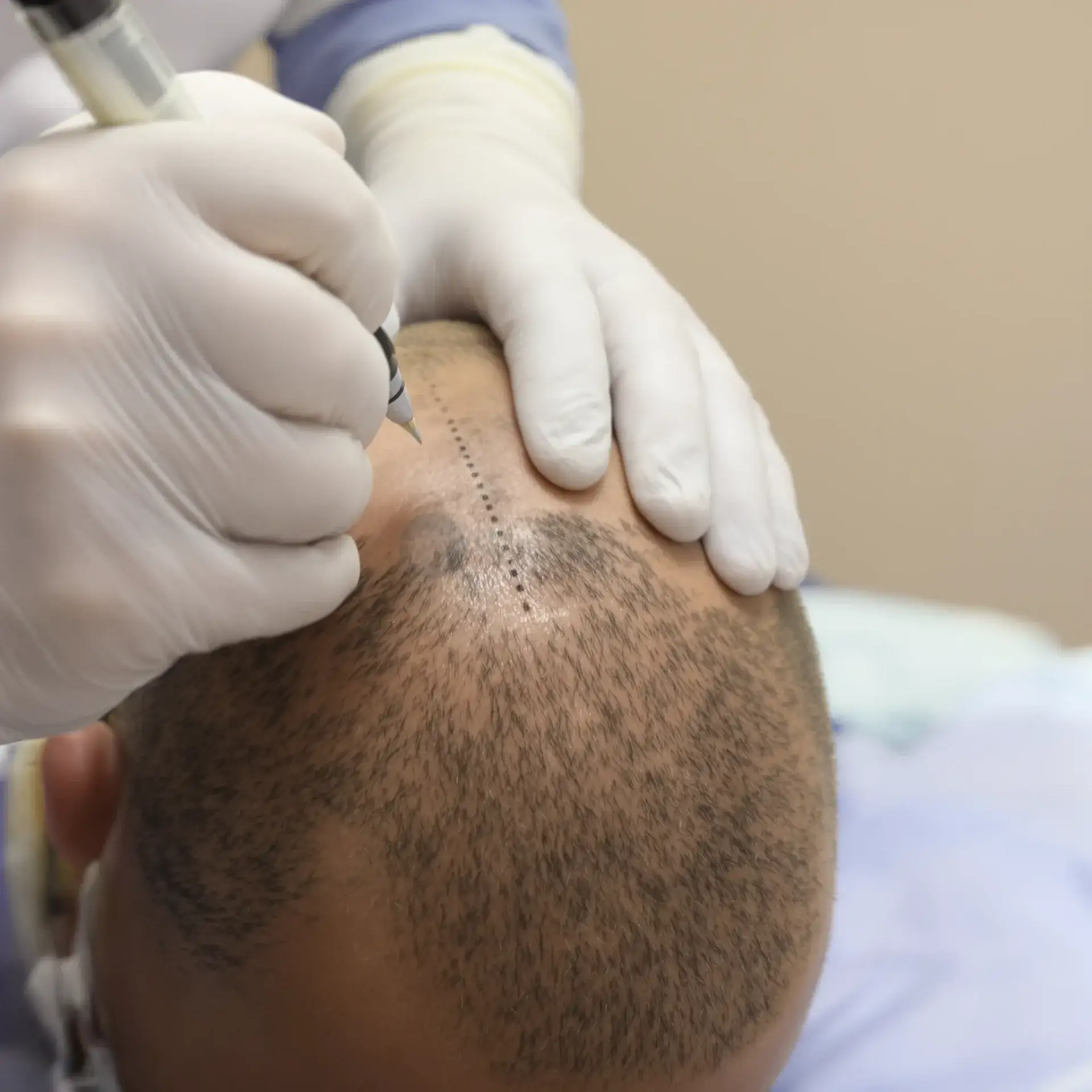 John Cena Hair Transplant: 20+ Hours Across Two Operations