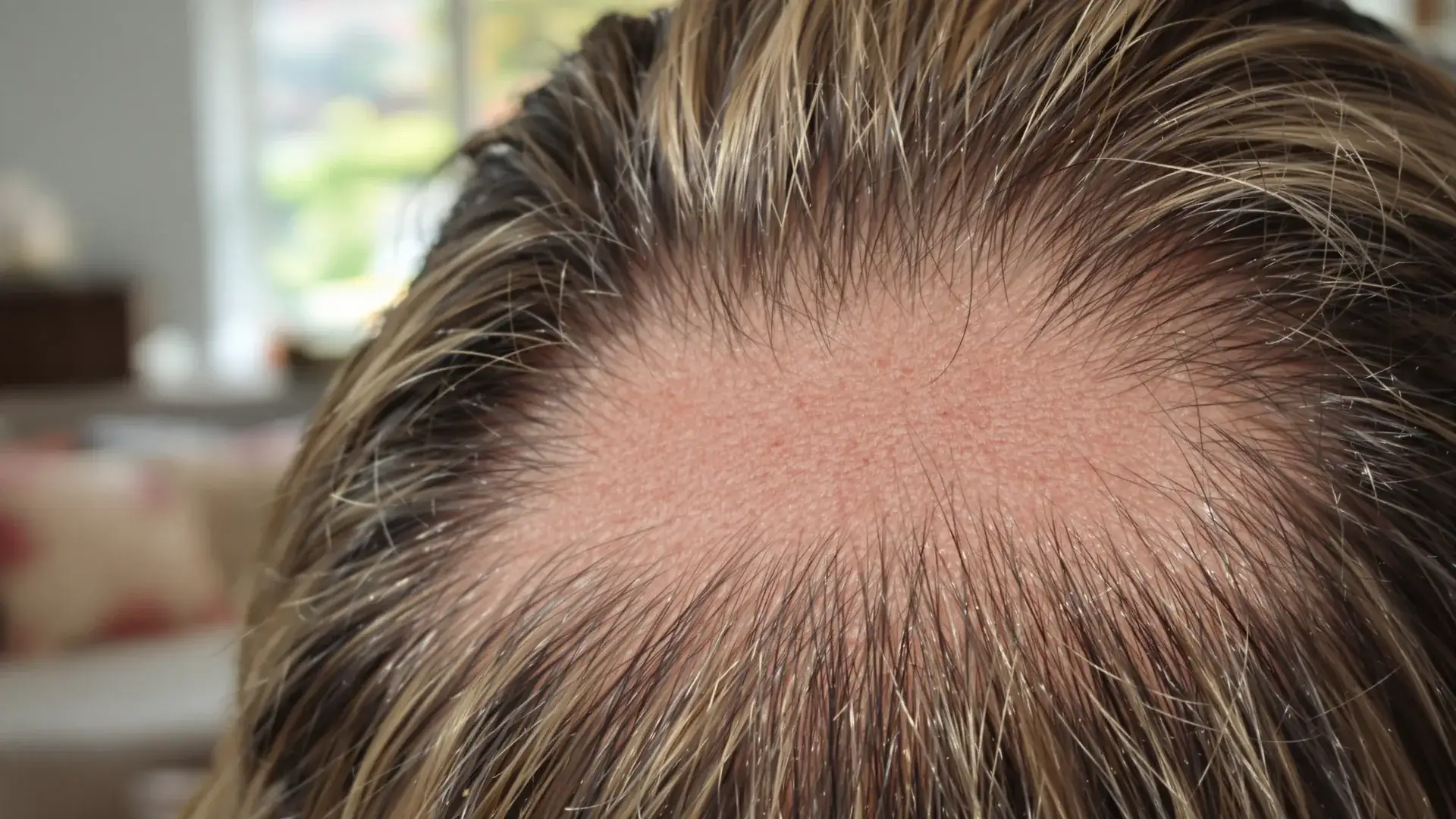 Trapianto di capelli di Theo Baker: cosa ha pubblicato lui stesso
