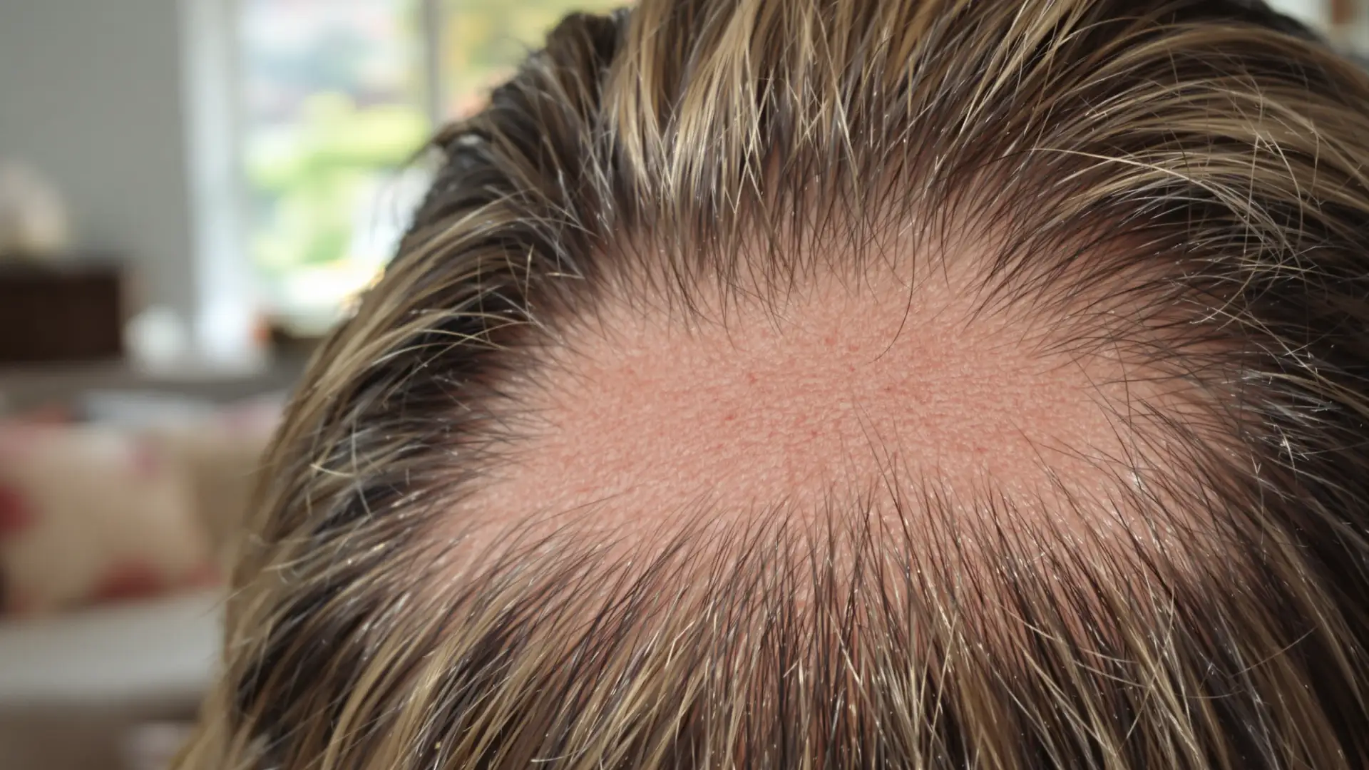 Generic stock illustration: an anonymous head seen from above with scalp visible through the hair at the crown. Not a photograph of any named person.