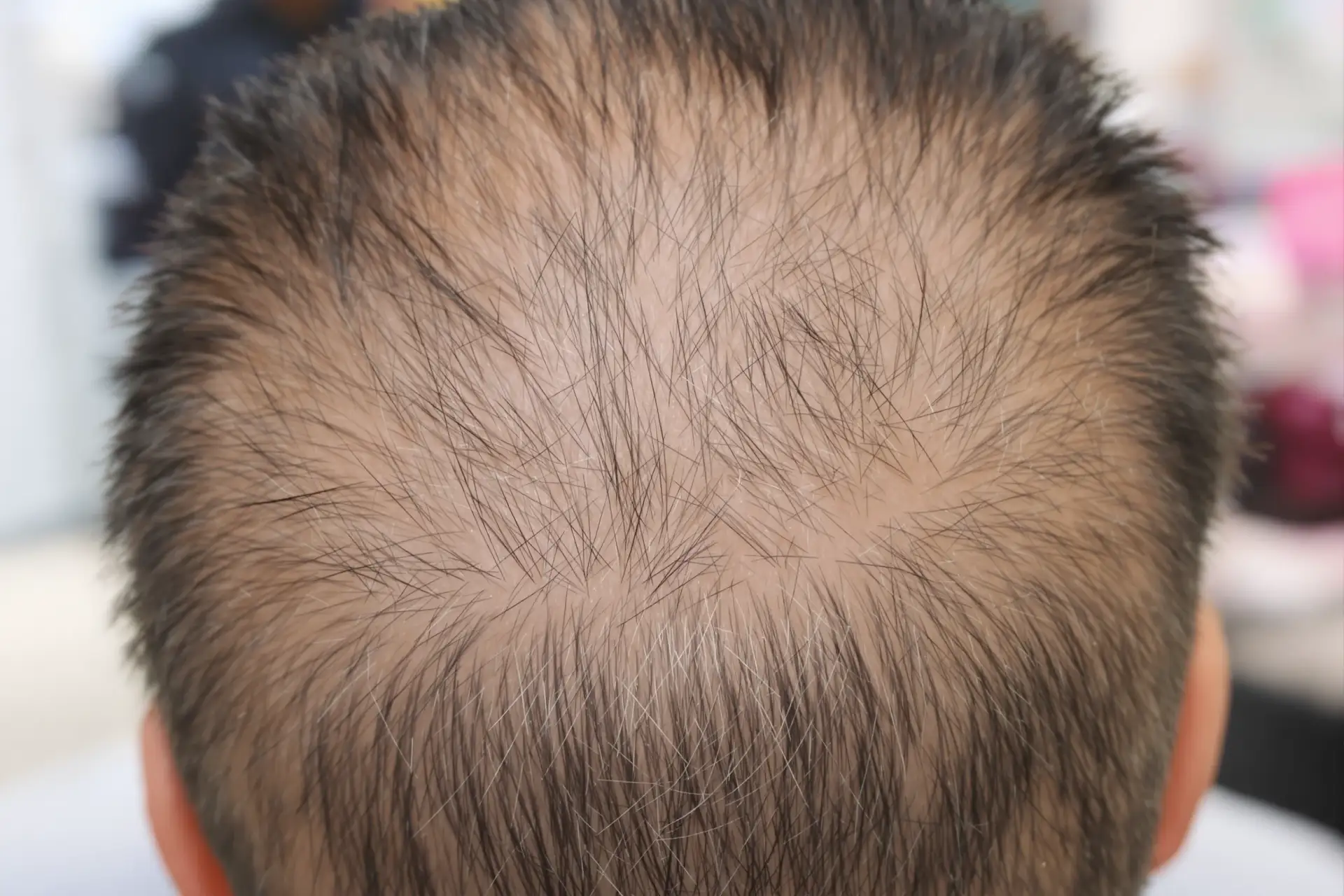 Trasplantes de Cabello en Turquía vs. Locales: Costo y Calidad