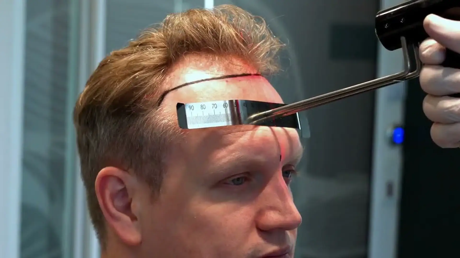 فيديوهات زراعة الشعر