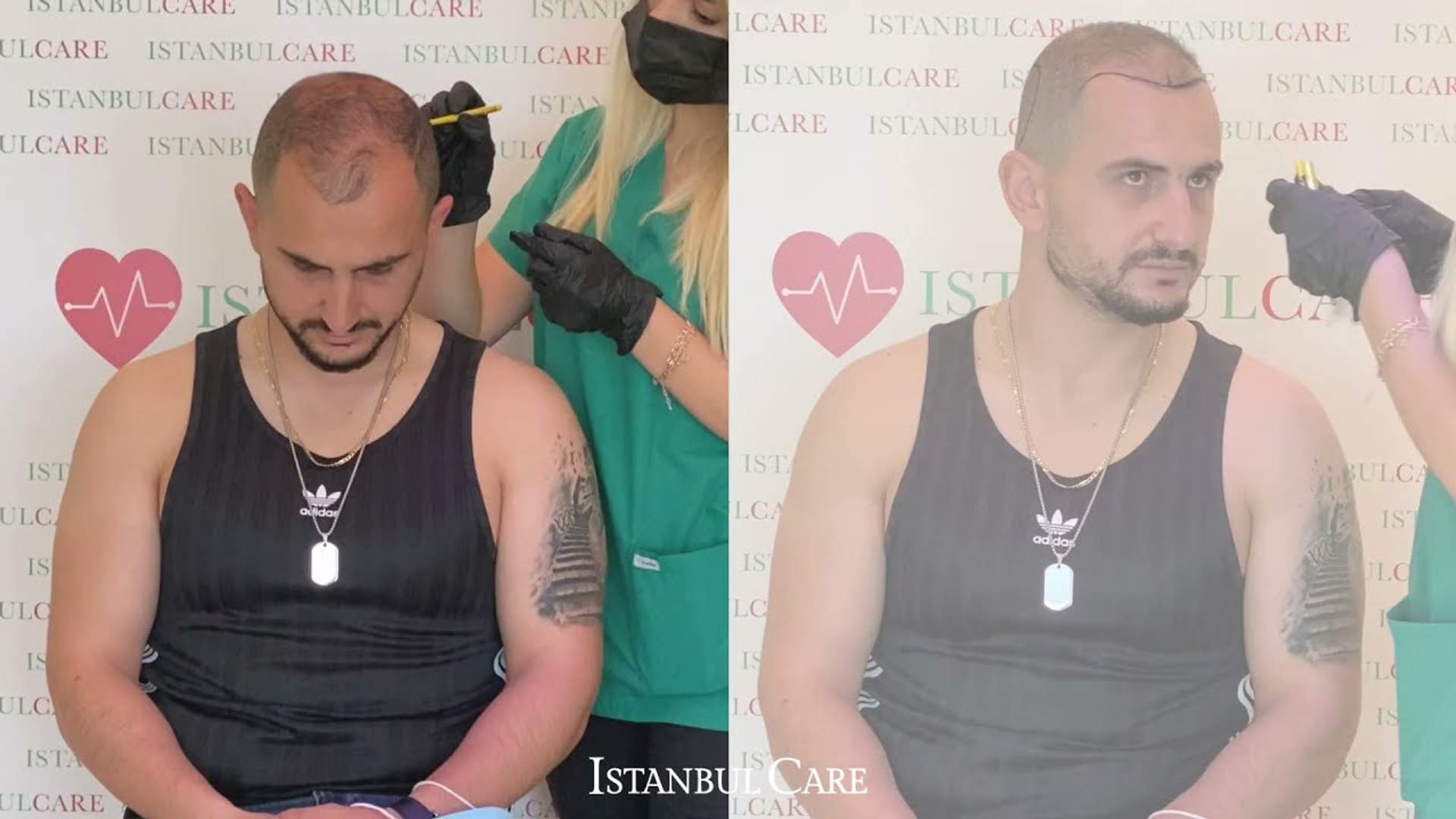 Transplant de păr pas cu pas, în albaneză (Video)