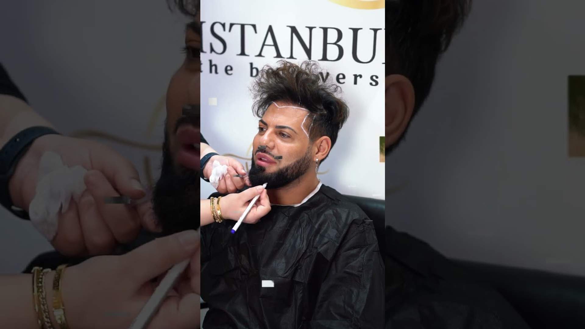 Hair Transplant in Istanbul: The Complete Process (Video)