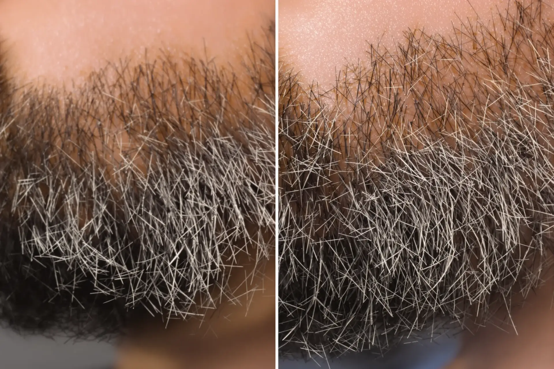 Récupération et résultats après une greffe de moustache