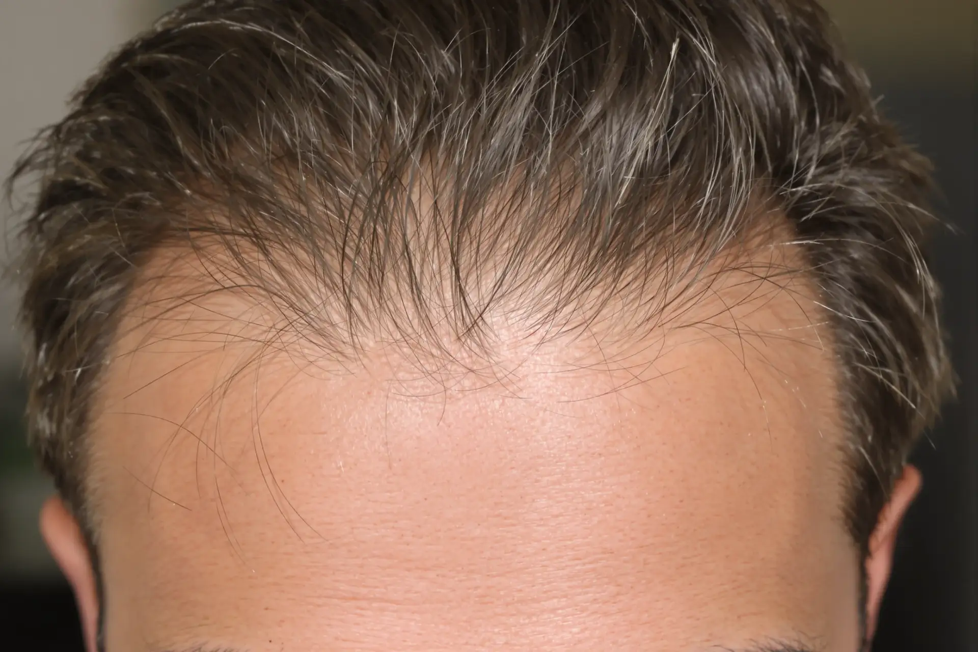 Calendrier des résultats de greffe de cheveux : mois par mois