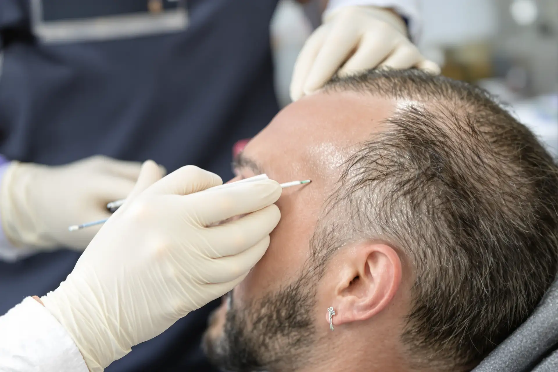 Comment fonctionne une greffe de cheveux: étape par étape — expliqué
