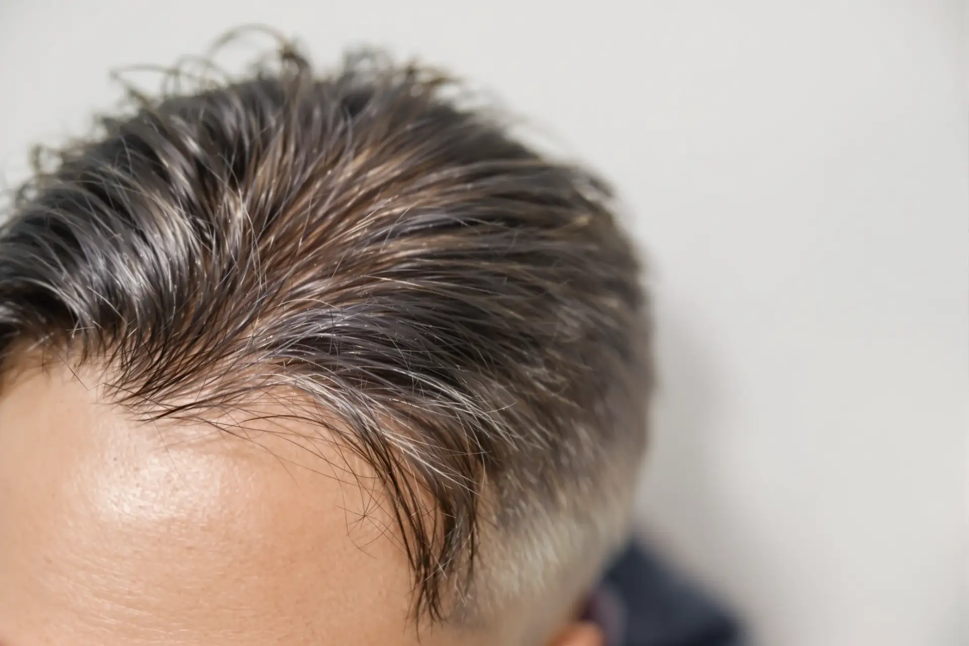 ¿Es Permanente un Trasplante de Cabello? Los Hechos