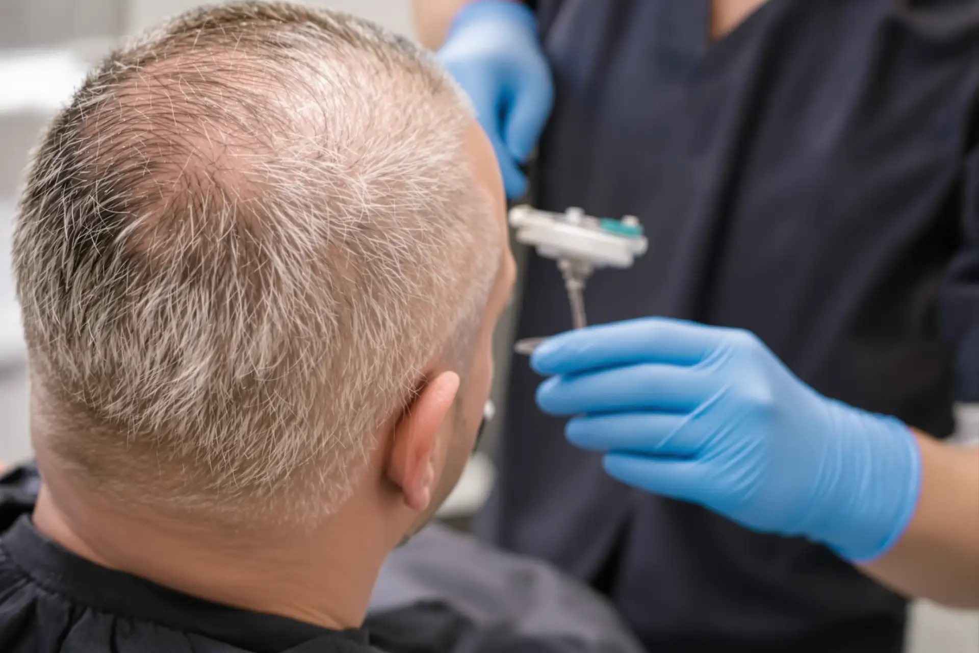 أنواع وطرق زراعة الشعر مقارنة