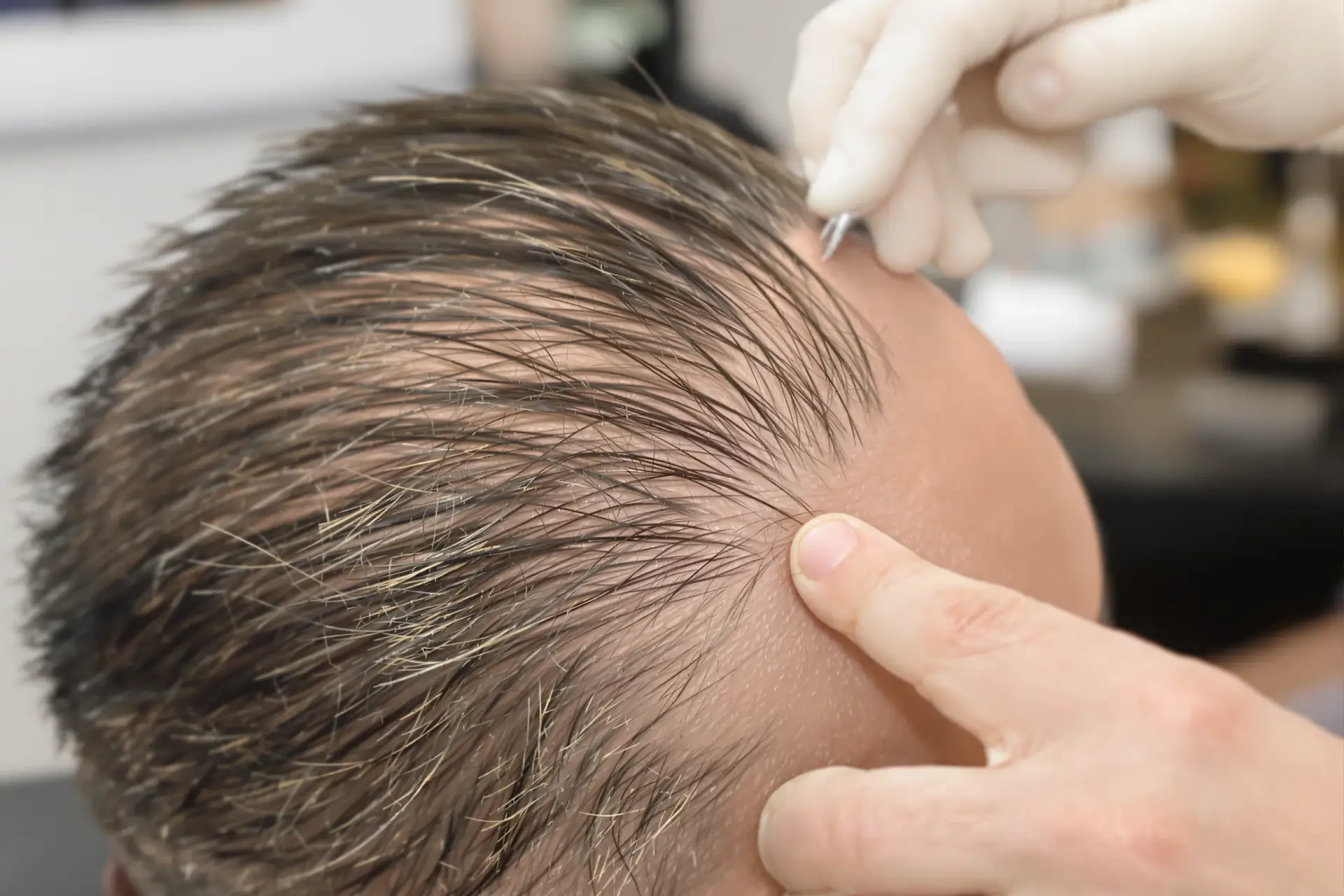 زراعة شعر الصدغين في تركيا بتقنية FUE