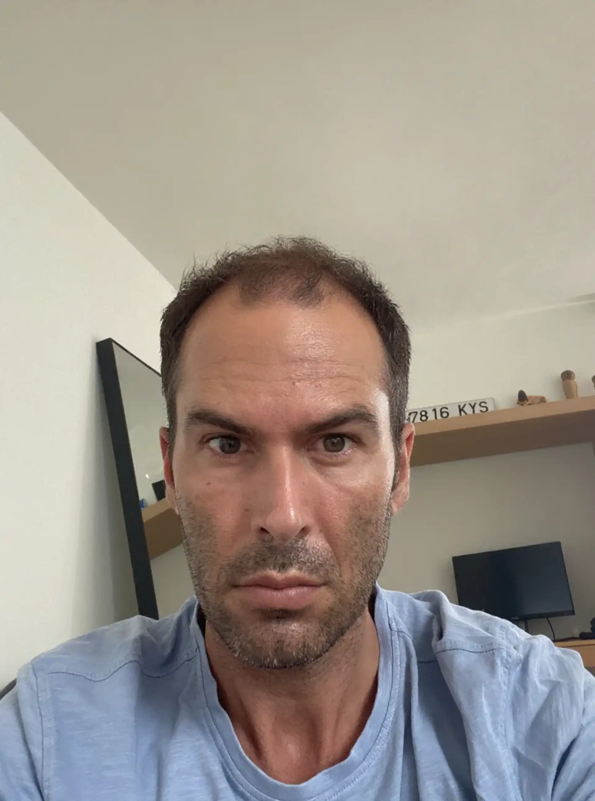 Hair Transplant Scars: FUE vs FUT Explained