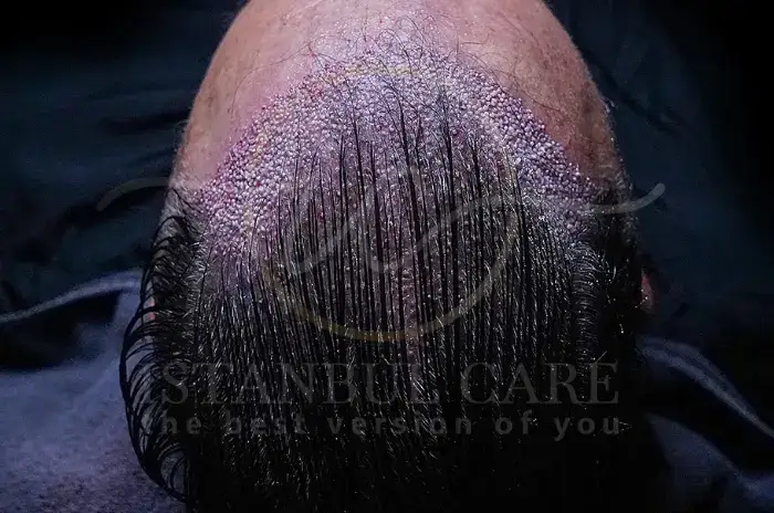 Best Hair Care Practices After a Hair Transplant