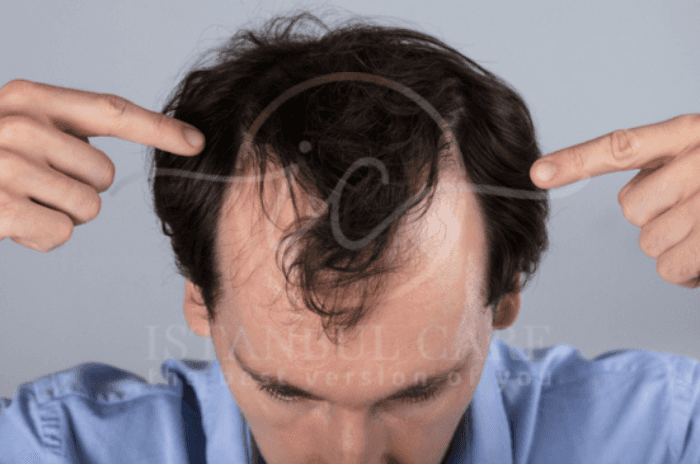 Le stress peut-il causer la perte de cheveux