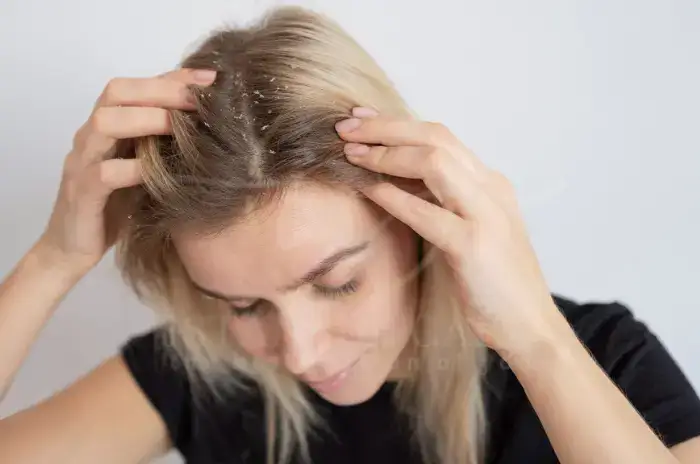 Comment traiter le cuir chevelu sec