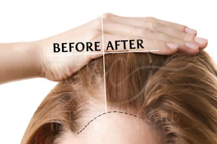 hairline-hair-transplant