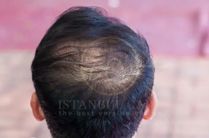 chronic telogen effluvium