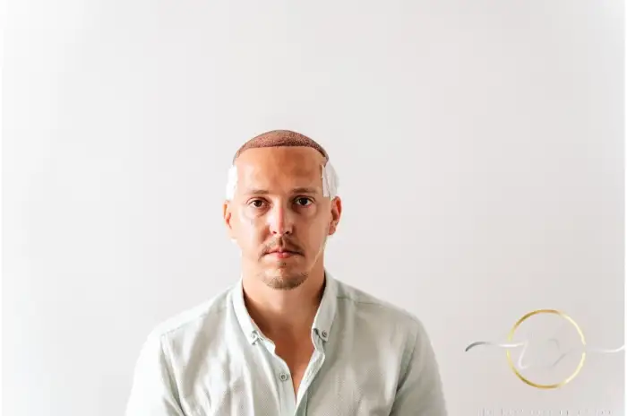 Trapianto di capelli FUT in Albania