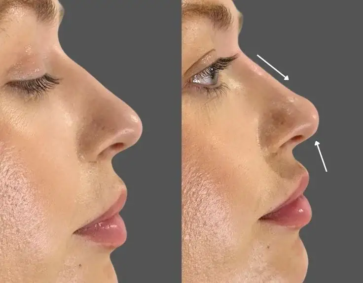 Rinoplastia em Istambul: Faz uma cirurgia ao nariz na Turquia