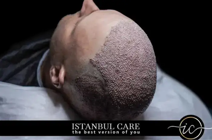type of hair transplant