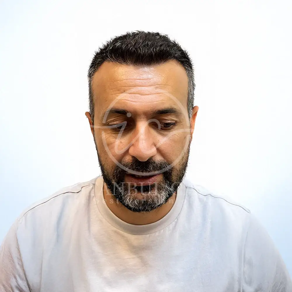 After FUE hair transplant in Istanbul
