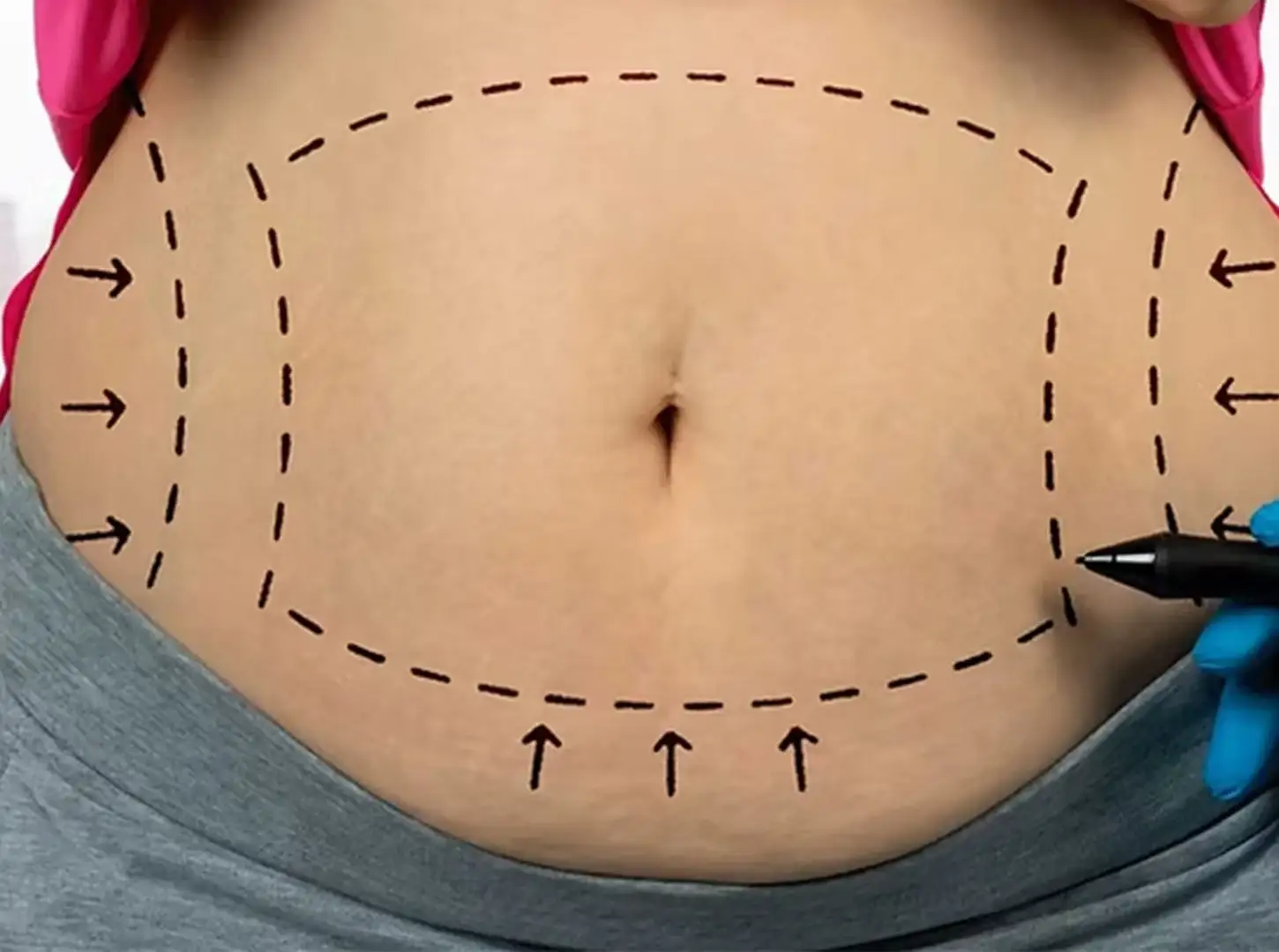 Marcas na barriga para lipoaspiração