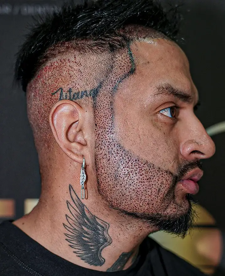 Bump on Scalp Ce que cela signifie et comment traiter