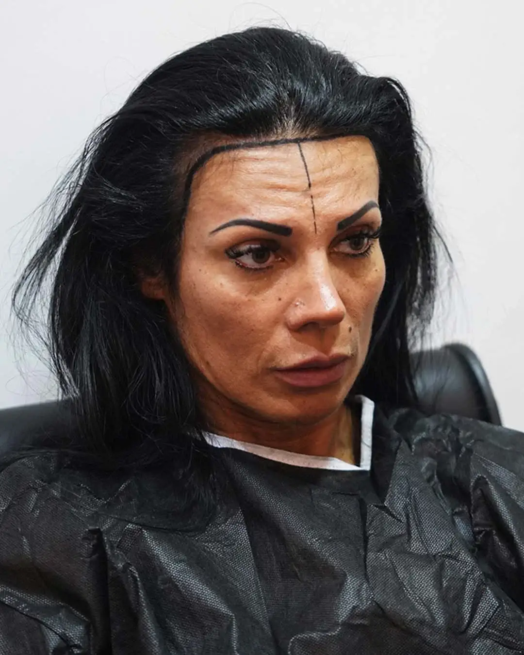 Procedura di trapianto di capelli femminile