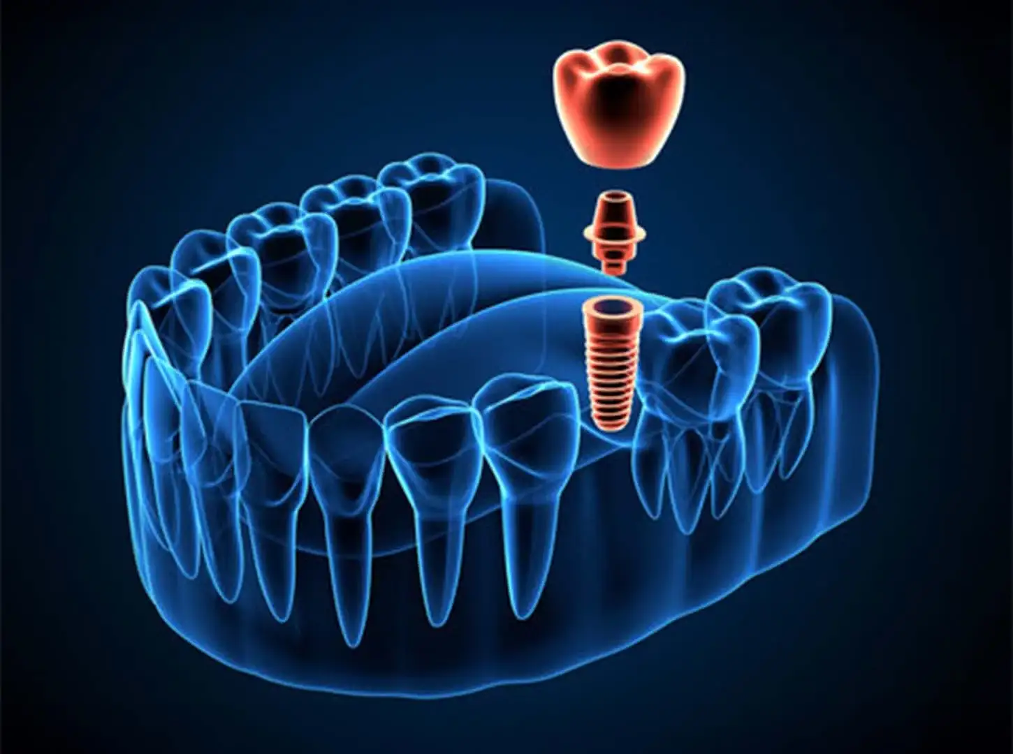 Ile implantów dentystycznych będę potrzebować?