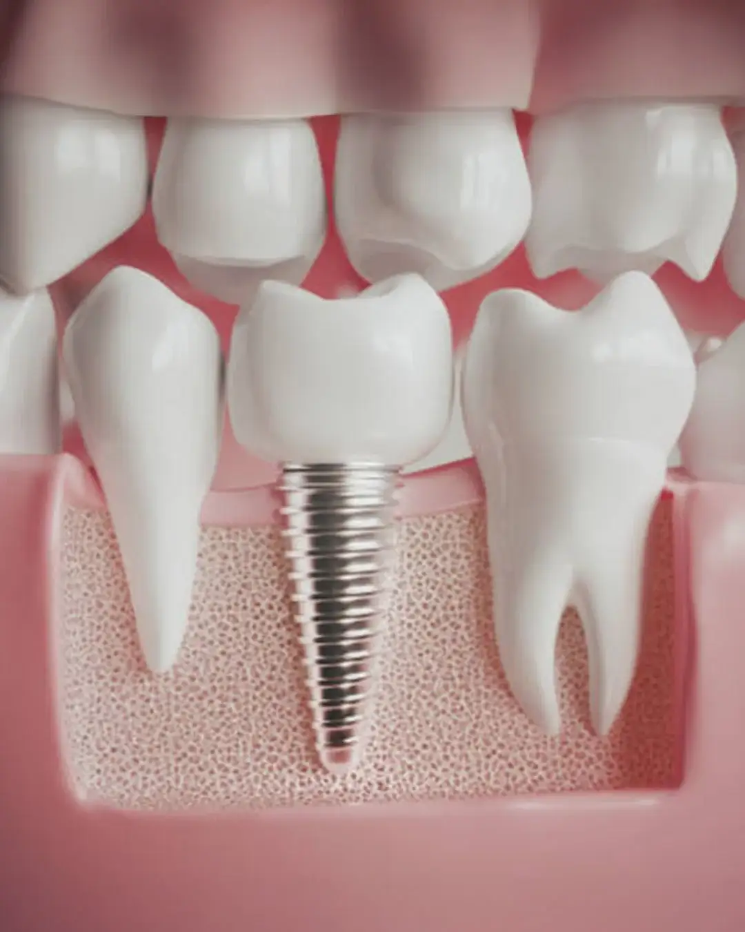 Trattamento implantare a Istanbul Care