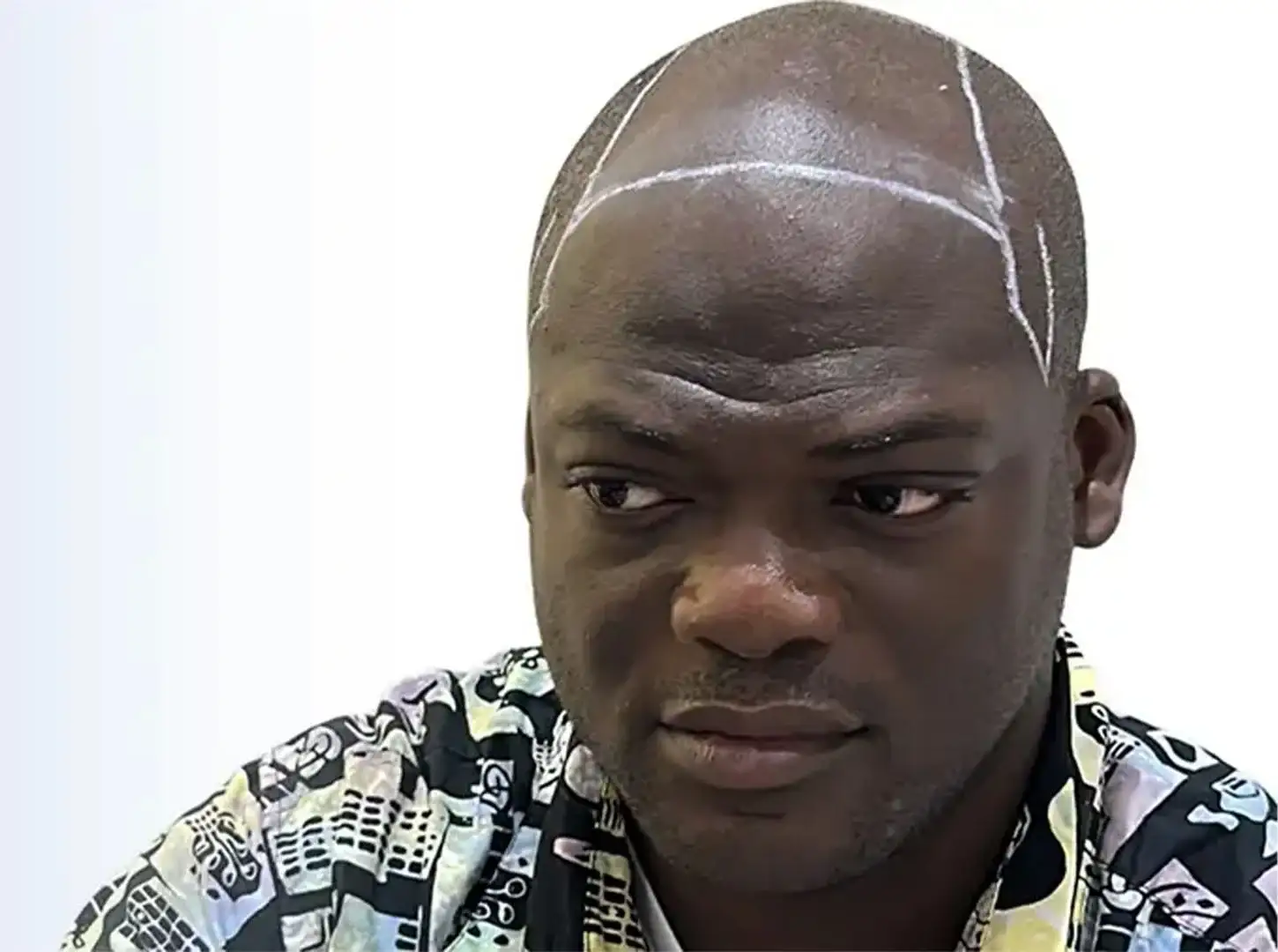 La procédure de greffe de cheveux Afro FUE étape par étape