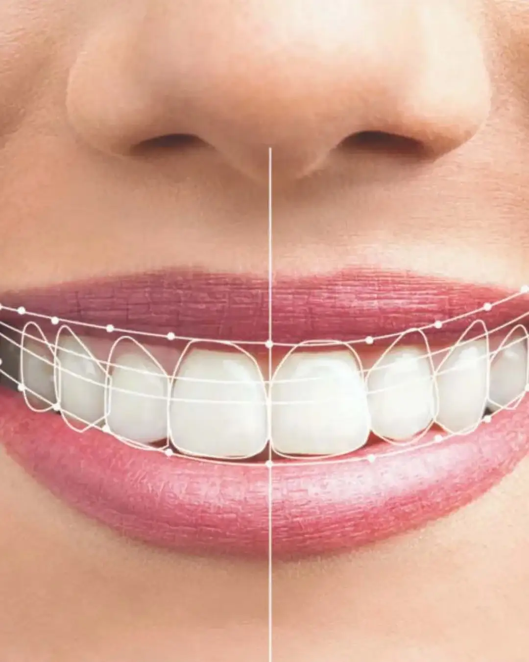 Primer plano de un rostro sonriente con dientes perfectamente alineados.