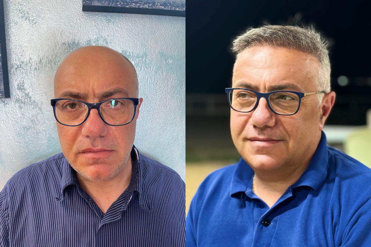 hair transplant before after image