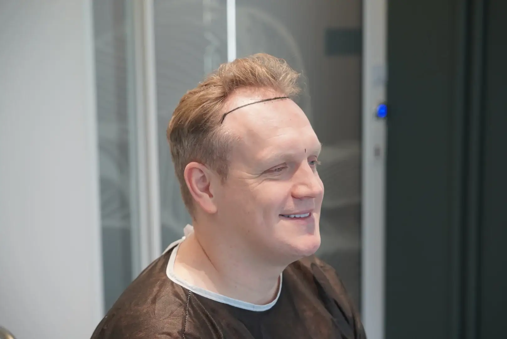influencer-photo hair transplant