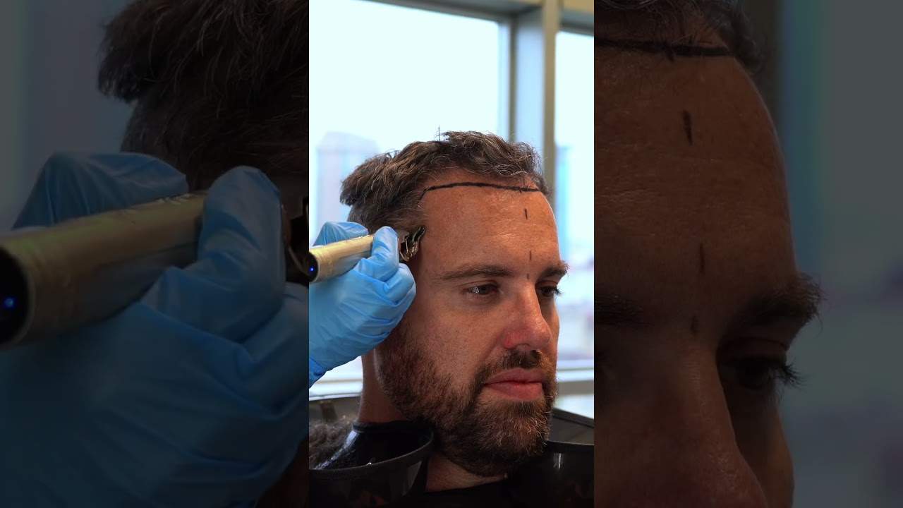Série de vidéos sur la greffe de cheveux DHI