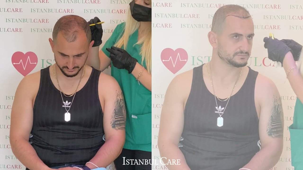 Przeszczep włosów krok po kroku, po albańsku (wideo)