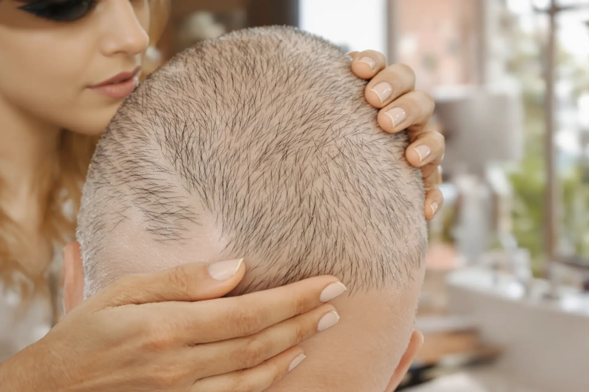 Alopecia Universalis: Ursachen und Prognose