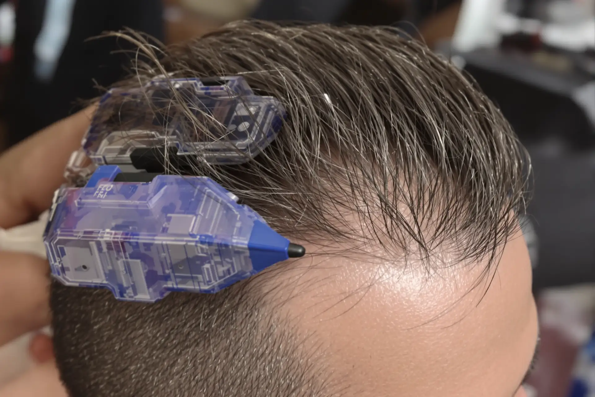 Trapianto di Capelli FUE in Turchia: Risposte alle FAQ