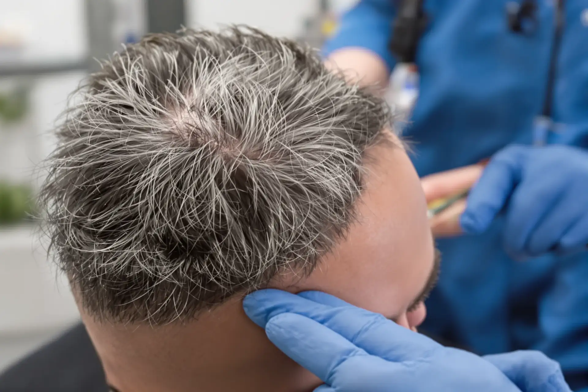 Greffe de Cheveux Avant Après : Étapes Clés