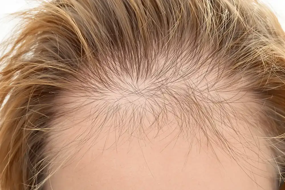 Signs of Telogen Effluvium: Symptoms Explained