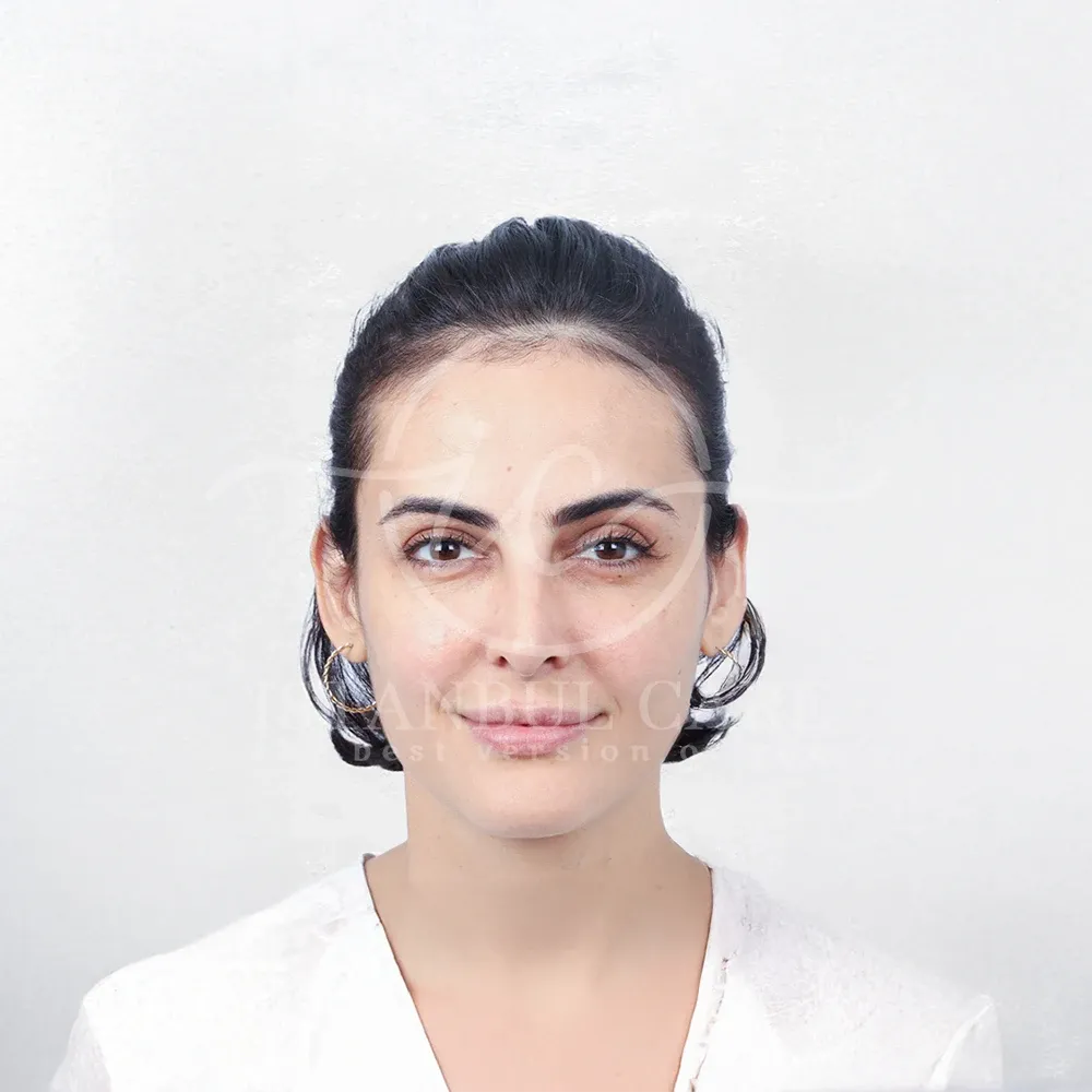 Hair transplant before photo at Istanbul Care — woman with dark hair tied back showing a high hairline and thin temples, front view