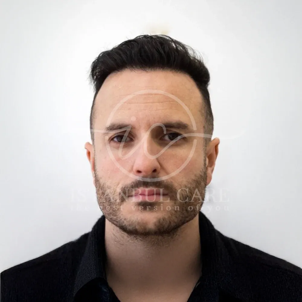 Foto dopo il trapianto di capelli presso Istanbul Care — uomo con camicia scura con linea frontale ricostruita e acconciata, vista frontale