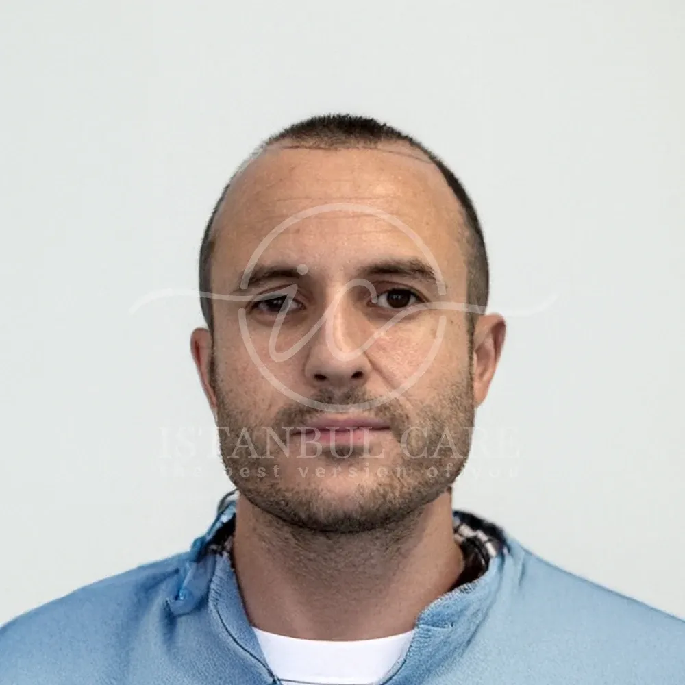 Foto prima del trapianto di capelli presso Istanbul Care — uomo con camicia azzurra con attaccatura stempiata, vista frontale
