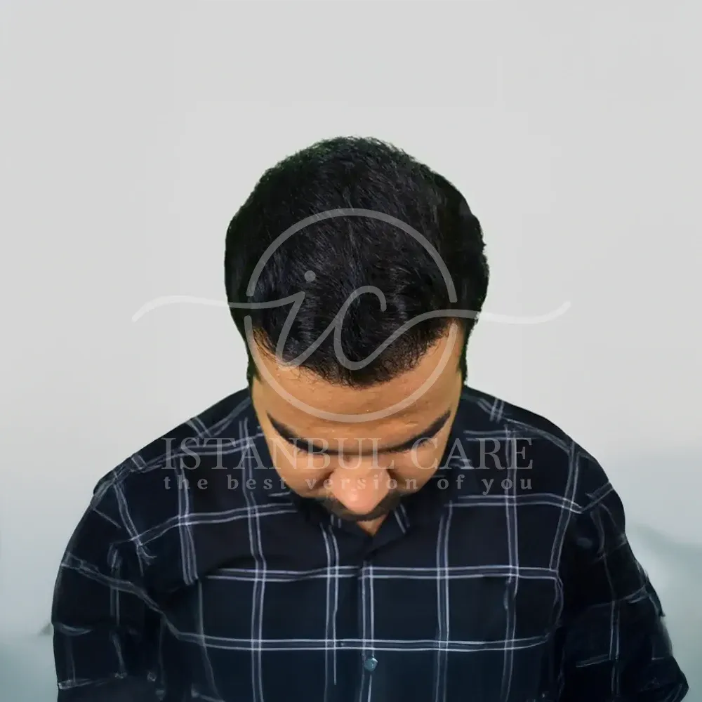 Foto dopo il trapianto di capelli presso Istanbul Care — vista dall'alto della testa di un uomo con capelli folti che coprono la corona