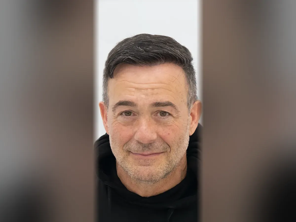 After DHI hair transplant, Istanbul Care patient 01