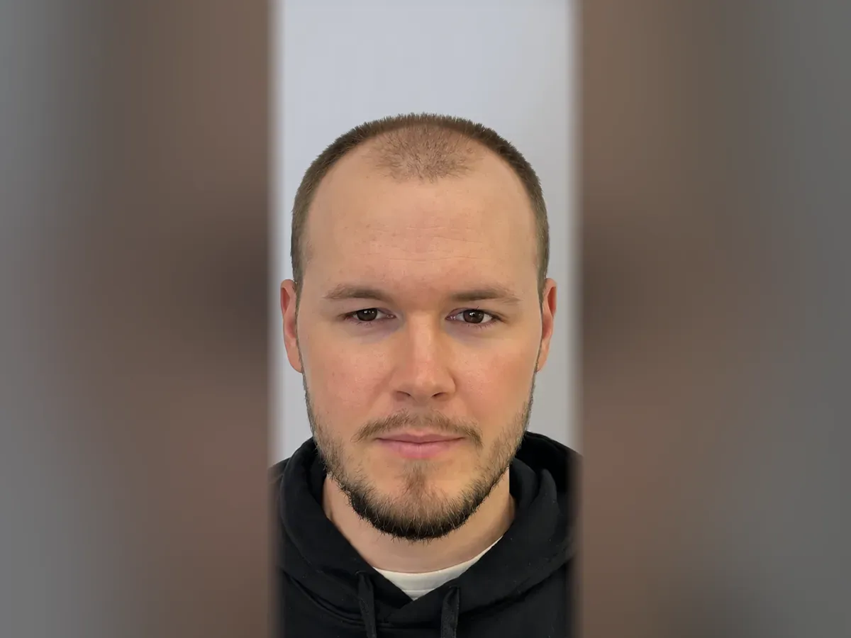 Before DHI hair transplant, Istanbul Care patient 03