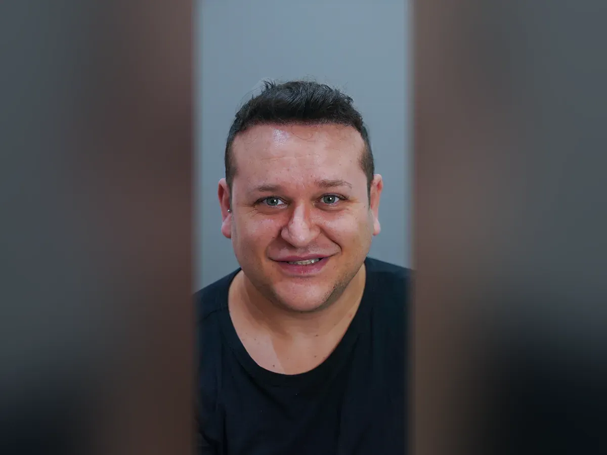 After DHI hair transplant, Istanbul Care patient 08