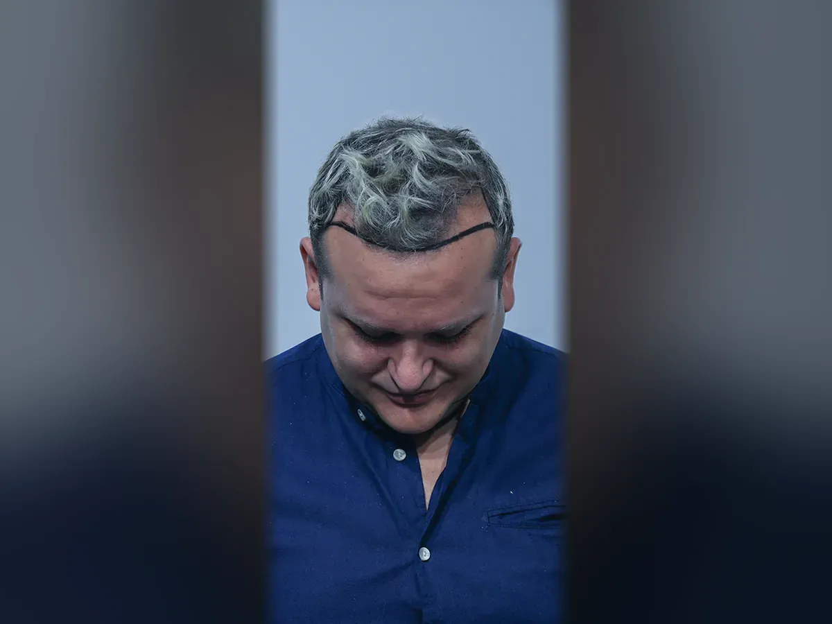 Before DHI hair transplant, Istanbul Care patient 08
