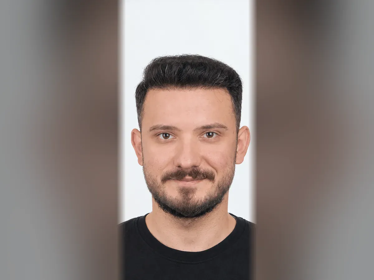 After DHI hair transplant, Istanbul Care patient 14